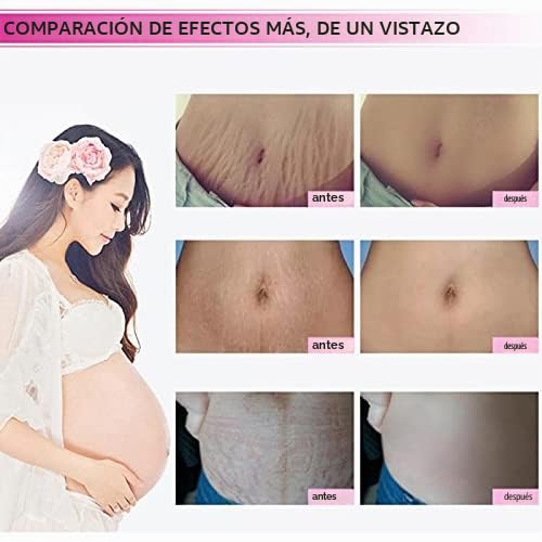 Crema para estrías y cicatrices de mango, crema para eliminar estrí...