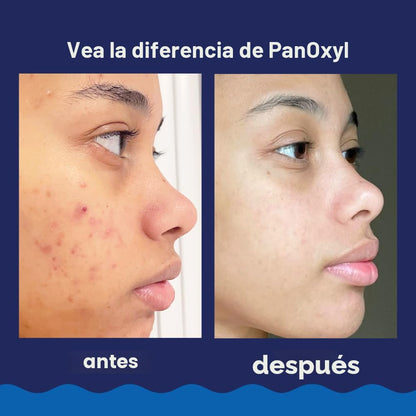 PanOxyl Lavado de espuma para acné con peróxido de benzoilo al 10%,...