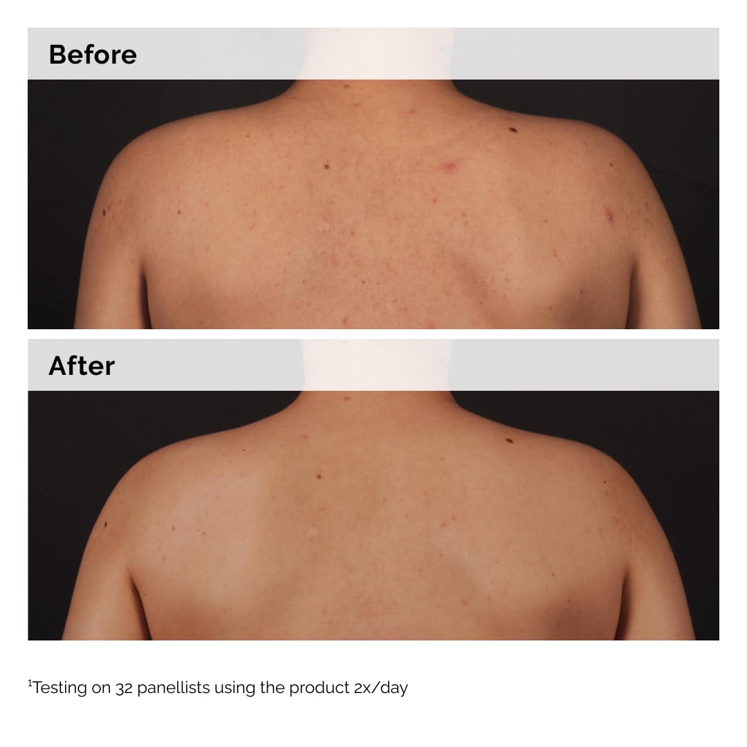 The Ordinary Suero corporal de ácido salicílico al 0.5%, tratamiento exfoliante para piel propensa al acné, 8.1 onzas líquidas