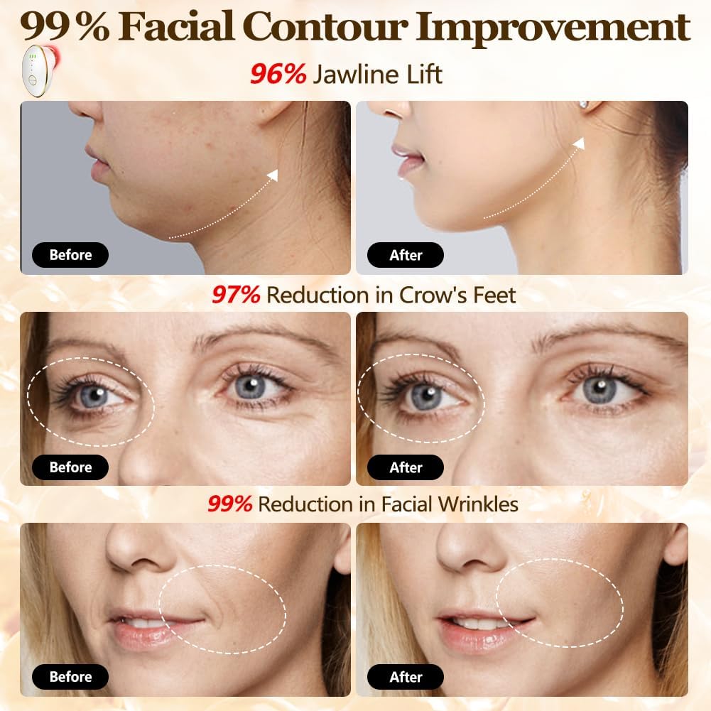 Juego de ventosas faciales para cara, dispositivo facial de microco...