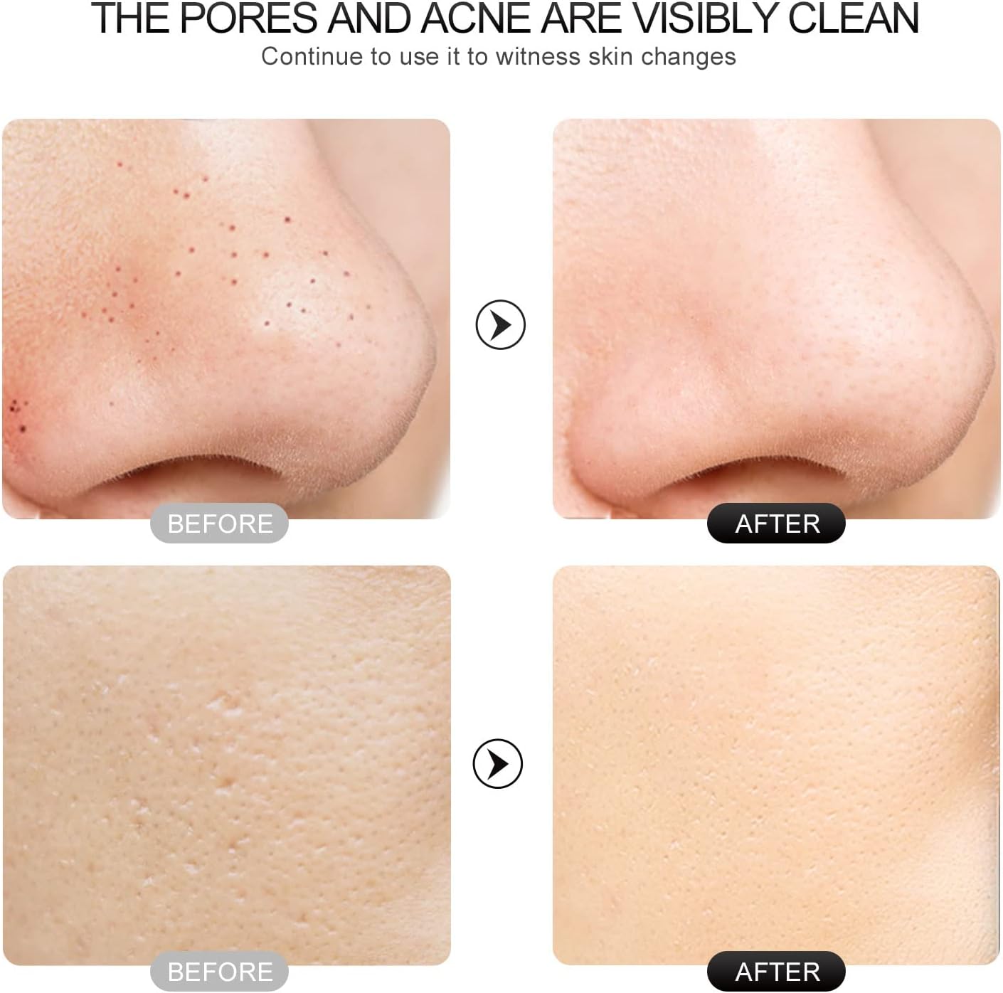 Espátula facial para exfoliar la piel, removedor de puntos negros A...