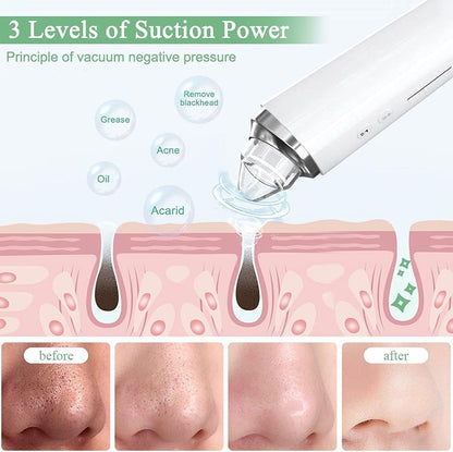 Aspirador de poros para eliminar puntos negros, limpiador facial vi...