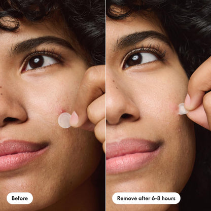 Mighty Patch™ Invisible+ Patch \u2013 The Barely-There Daytime Hydr...