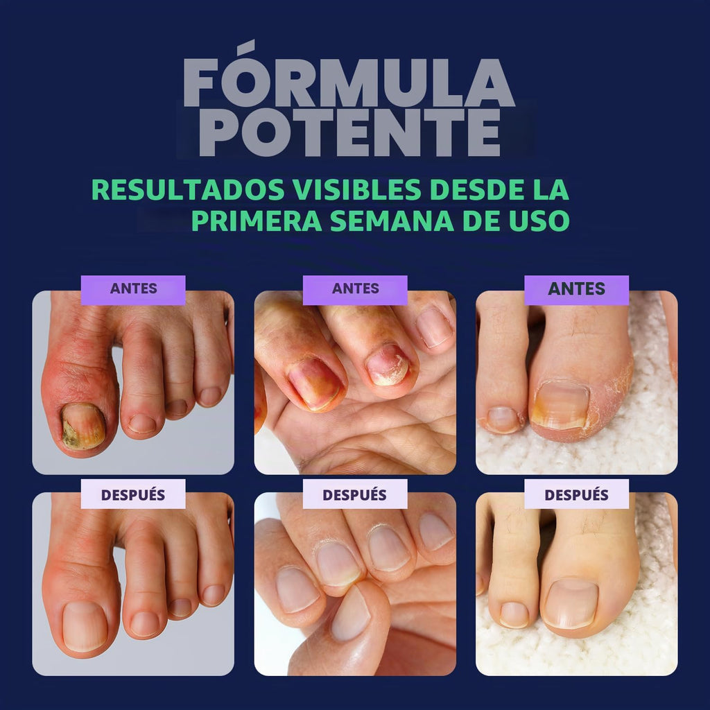 Orivelle Lápiz de Cuidado de Uñas del Pie - Remedio de Uñas de los...