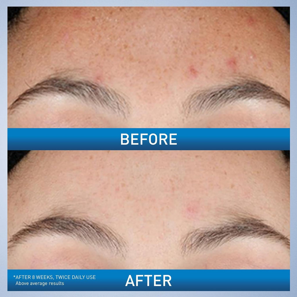 CeraVe Suero de Retinol Renovador para Marcas Post-Acné, Formulado...