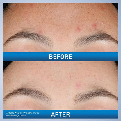CeraVe Suero de Retinol Renovador para Marcas Post-Acné, Formulado...