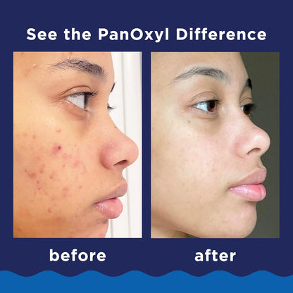 PanOxyl Espuma de lavado para el acné con peróxido de benzoilo 10%...