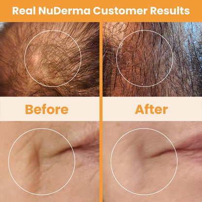 Pure Daily Care NuDerma Varita Manual para Terapia de la Piel con N...