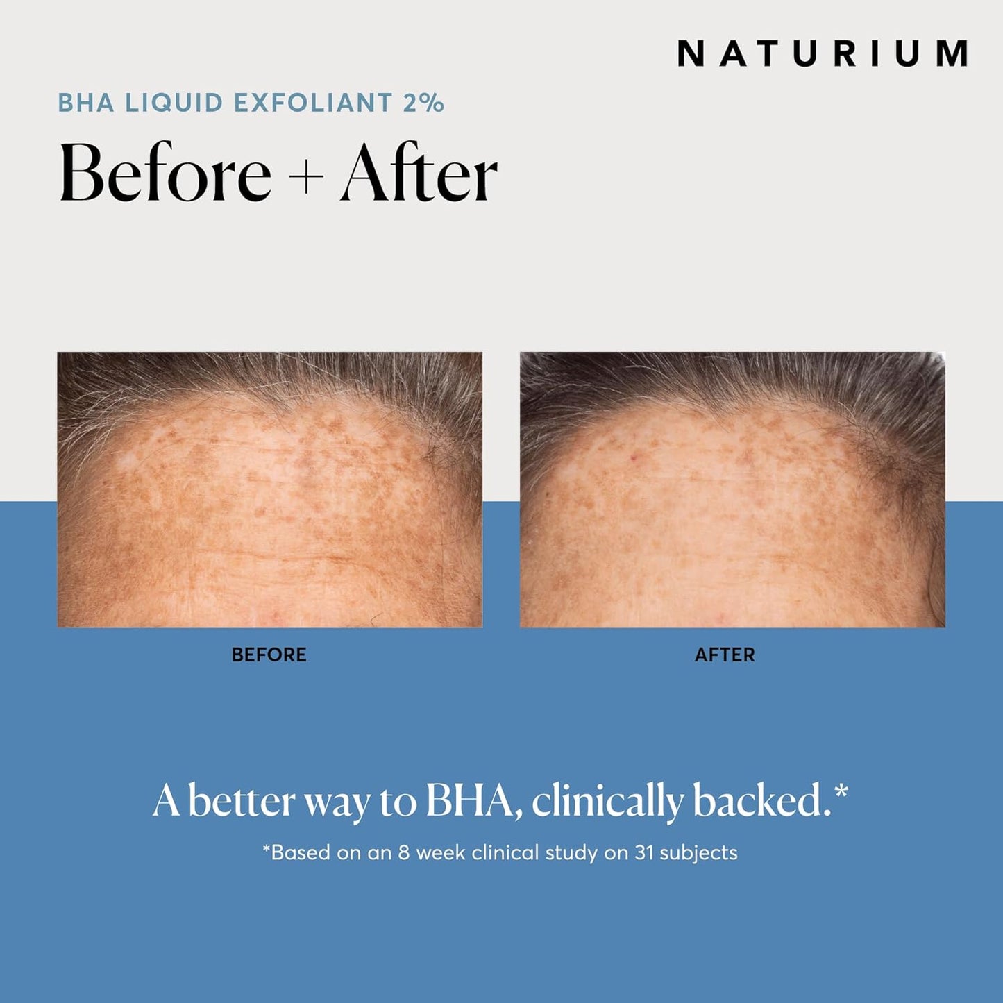 Naturium BHA Exfoliante Líquido 2%, Tratamiento Exfoliante de Poros Leave-on para Rostro y Cuidado de la Piel, con Ácido Salicílico y Ácidos de Frutas Bioactivos, El Empaque Puede Variar, 4 oz