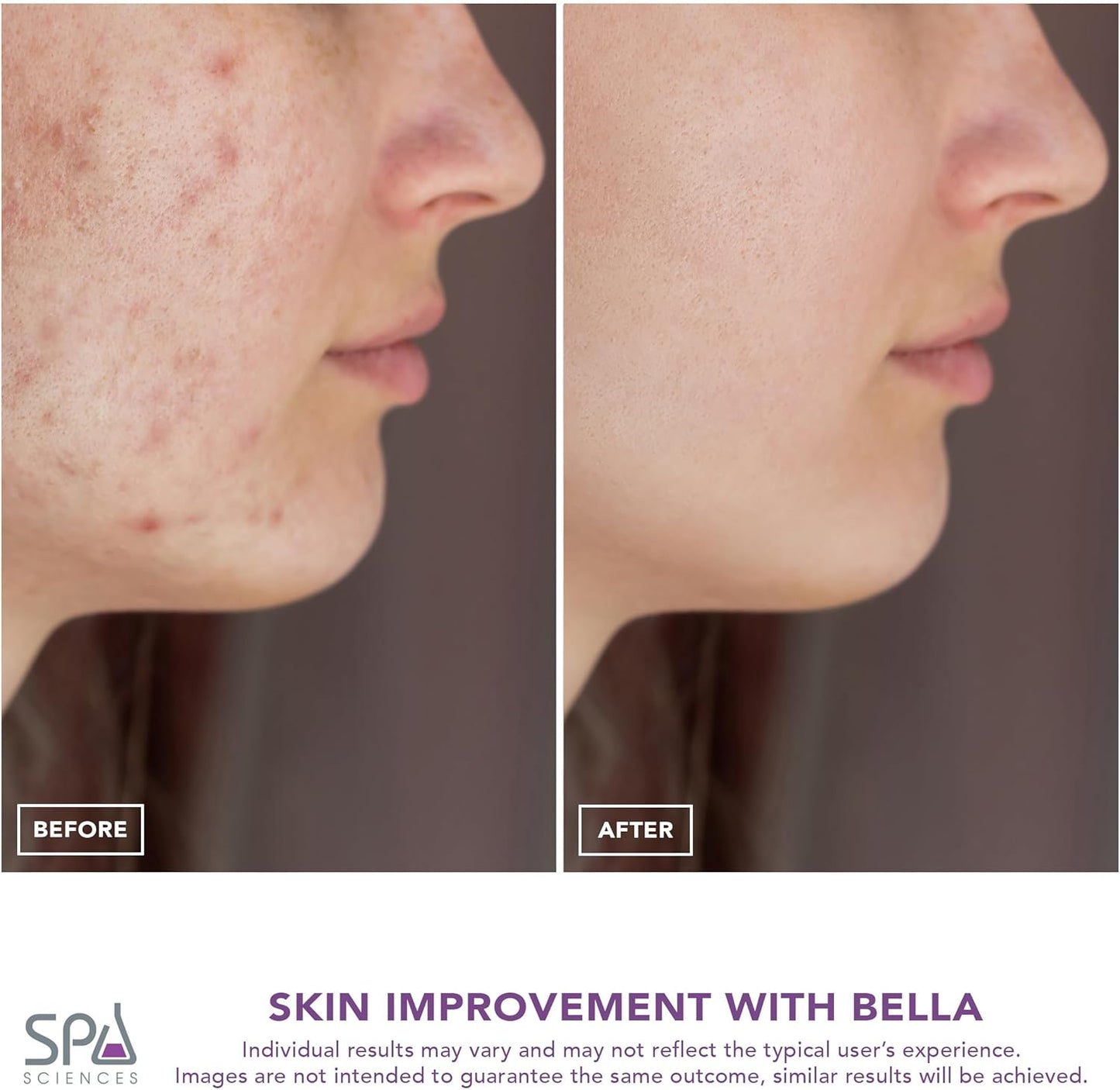 Spa Sciences - Extractor de poros Bella Microdermabrasion y Nano Mi...
