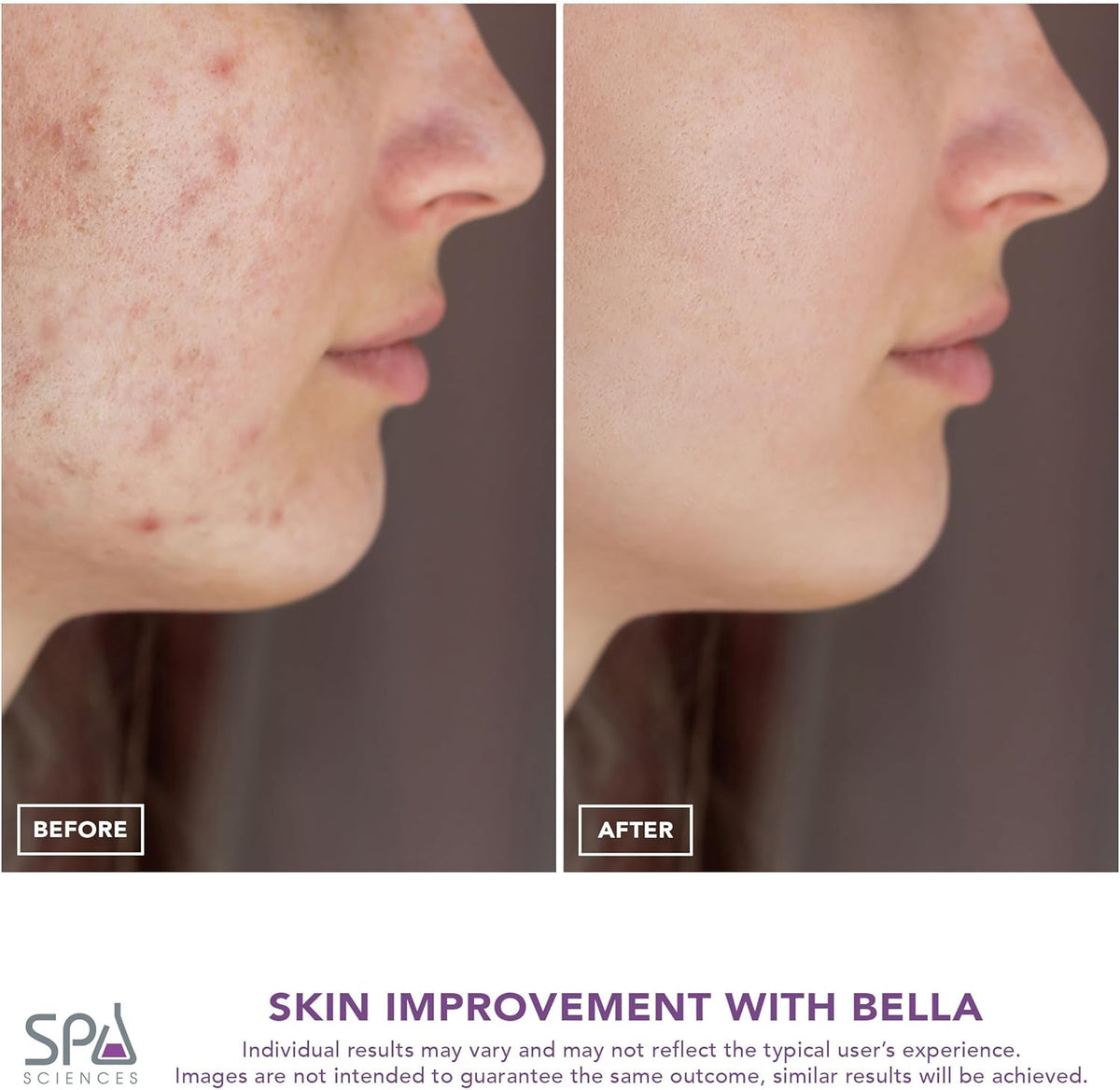 Spa Sciences - Extractor de poros Bella Microdermabrasion y Nano Mi...