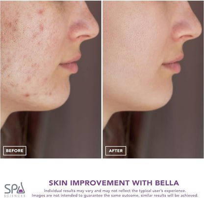 Spa Sciences - Extractor de poros Bella Microdermabrasion y Nano Mi...