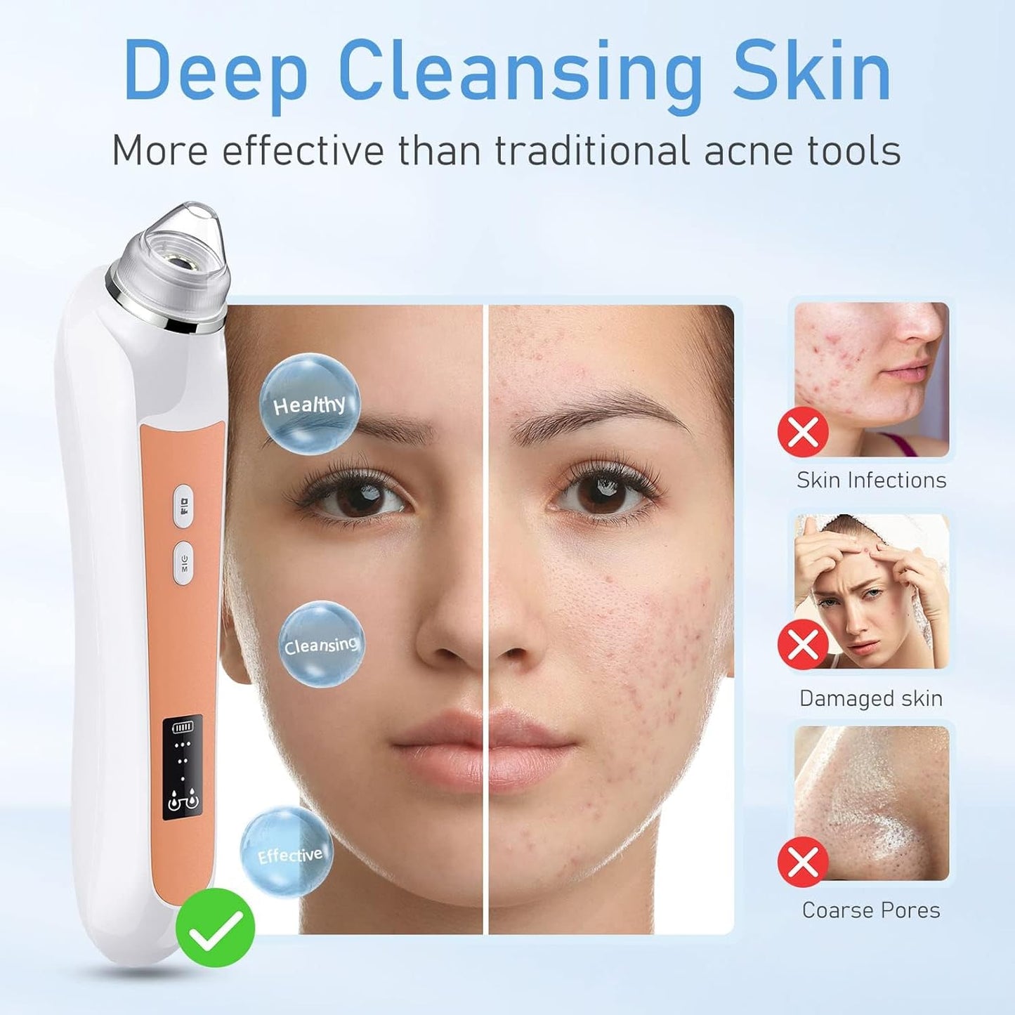 Aspiradora facial para eliminar puntos negros, removedor de puntos...