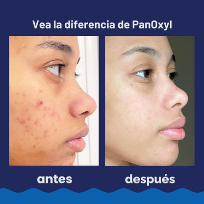 PanOxyl Jabón Espumoso para el Acné con Peróxido de Benzoilo 10% de...