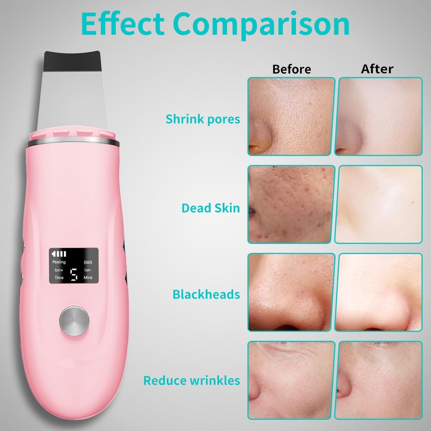 Espátula facial para limpieza profunda - Removedor de puntos negros...