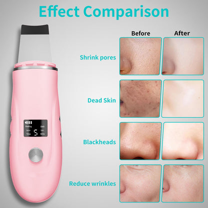 Espátula facial para limpieza profunda - Removedor de puntos negros...