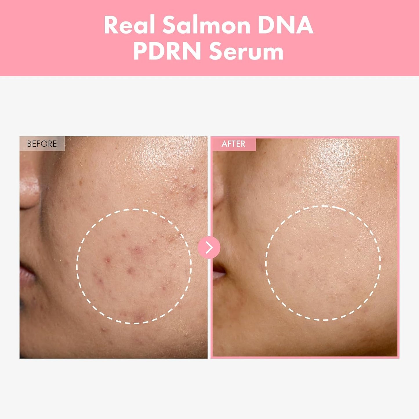 TOSOWOONG Suero Pink Peptide 12 PDRN con ADN de salmón PDRN, 33 ml/1.11 oz, 10320 ppm, 12 péptidos, niacinamida, brillo para la piel, hidratante, humectante, tono de piel desigual, cuidado coreano