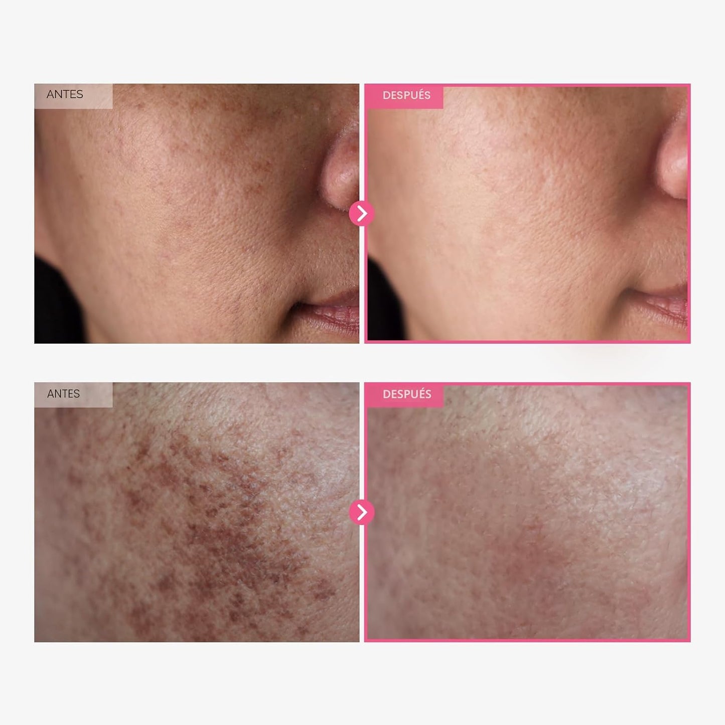 TOSOWOONG Arbutin 7% + Ácido Tranexámico 4% Crema, 70,000ppm Arbutin, 40,000ppm TXA, Niacinamida, Glutatión, Manchas Oscuras, Pecas, Imperfecciones, Pigmentación, Cuidado de la Piel Coreana, 50ml