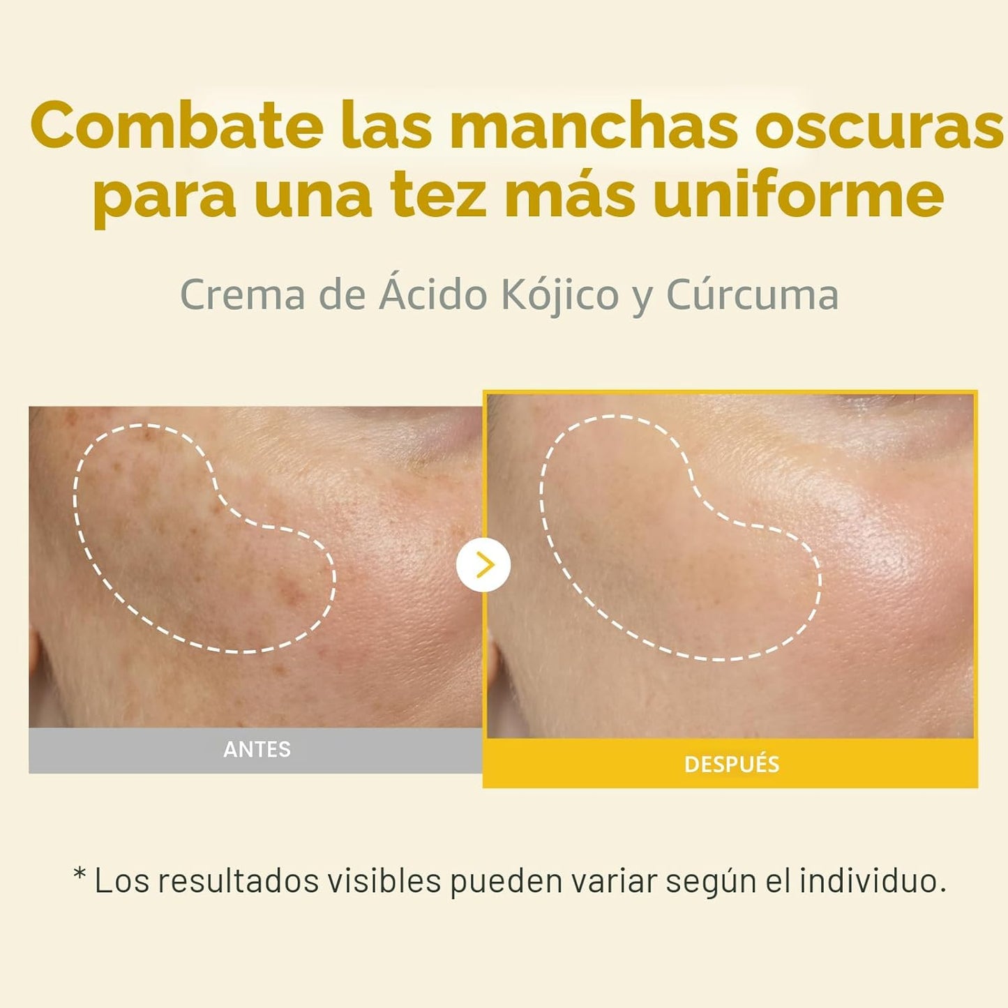 TOSOWOONG Crema de cúrcuma de ácido kójico, 99% de pureza de ácido...