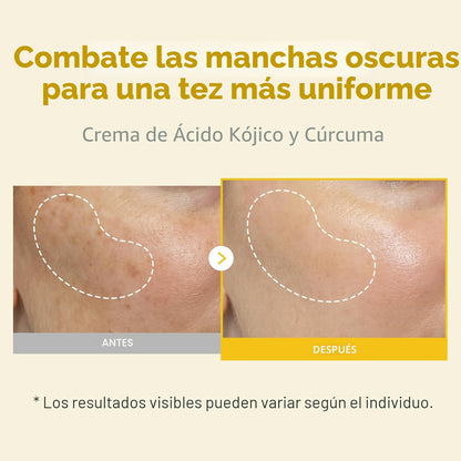 TOSOWOONG Crema de cúrcuma de ácido kójico, 99% de pureza de ácido...