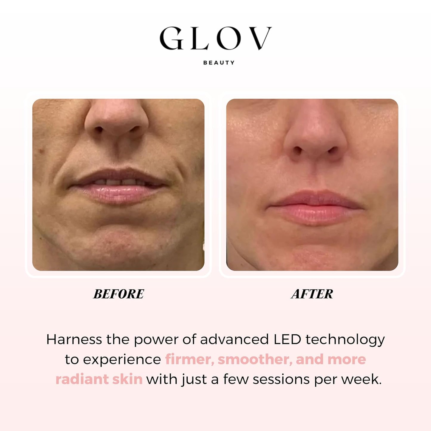 Glov Beauty - Máscara facial LED antienvejecimiento para terapia de...