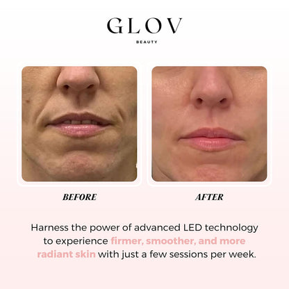 Glov Beauty - Máscara facial LED antienvejecimiento para terapia de...