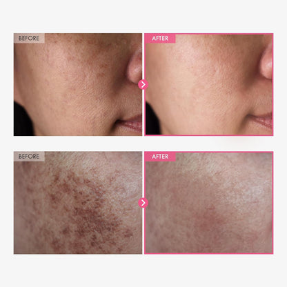 TOSOWOONG Arbutin 7% + Ácido Tranexámico 4% Crema, 70,000ppm Arbutin, 40,000ppm TXA, Niacinamida, Glutatión, Manchas Oscuras, Pecas, Imperfecciones, Pigmentación, Cuidado de la Piel Coreana, 50ml