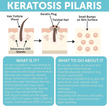 Tratamiento de queratosis pilaris | Loción de queratosis pilaris co...