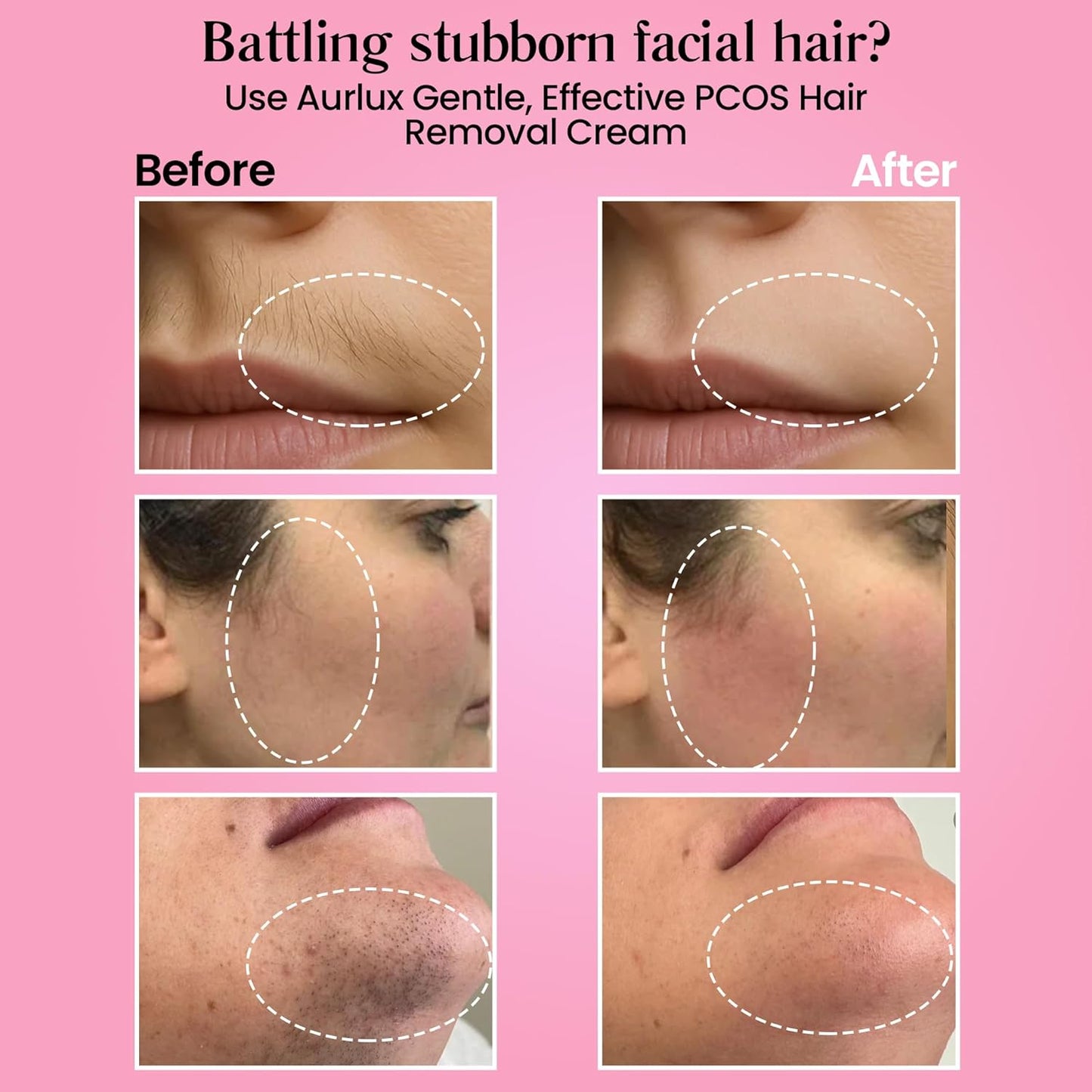 Aurlux Crema de depilación instantánea para mujeres, removedor de v...