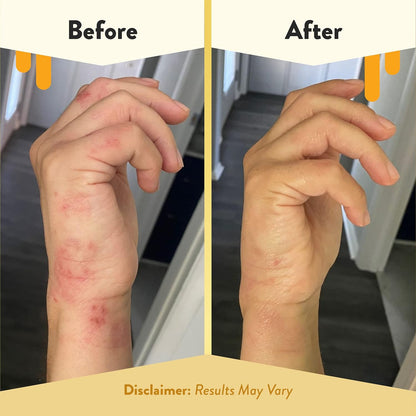 ECZEMA HONEY Aceite corporal antioxidante – Spray de aceite corporal para después de la ducha para la piel – Aceite hidratante sensible y propenso al eczema – Aceites corporales sin perfume para mujeres, hombres y niños (8 onzas líquidas)