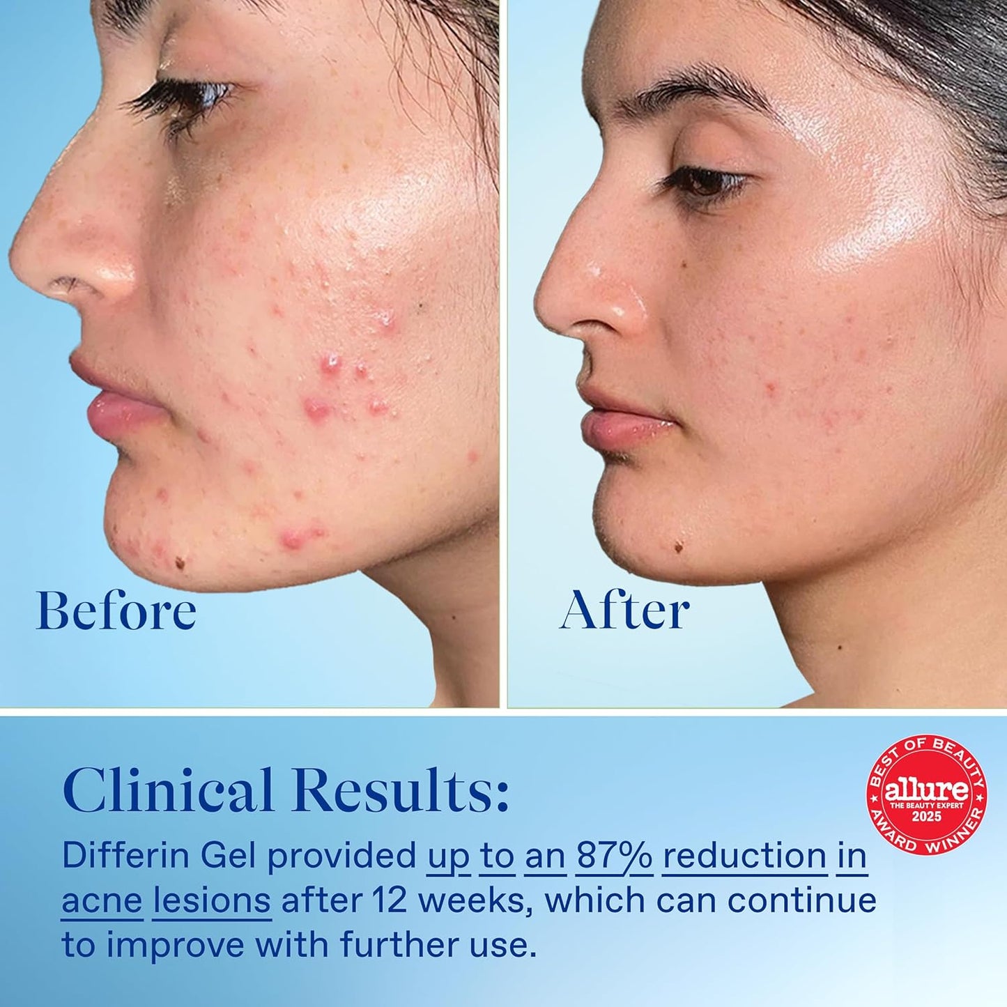 Gel de tratamiento para el acné Differin, suministro de 90 días, tratamiento retinoide para la cara con 0.1% de adapalene, cuidado suave de la piel para pieles sensibles con tendencia al acné, bomba