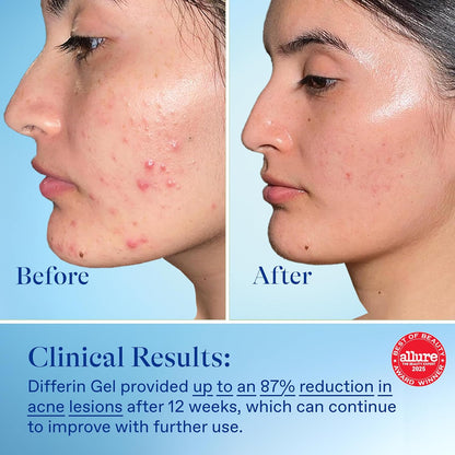 Gel de tratamiento para el acné Differin, suministro de 90 días, tratamiento retinoide para la cara con 0.1% de adapalene, cuidado suave de la piel para pieles sensibles con tendencia al acné, bomba