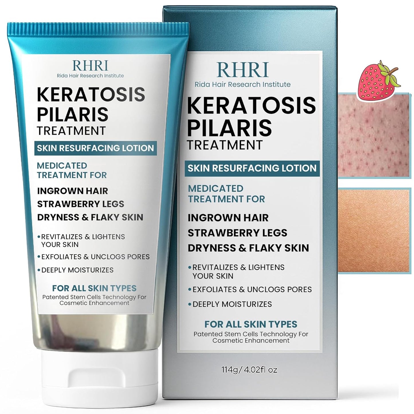 Tratamiento de queratosis pilaris | Loción de queratosis pilaris co...