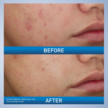 CeraVe Crema Espumosa Limpiadora para el Acné, Limpiador Suave para Rostro y Cuerpo con Peróxido de Benzoilo al 10%, Ácido Hialurónico y Niacinamida, Tratamiento con Peróxido de Benzoilo al 10% que