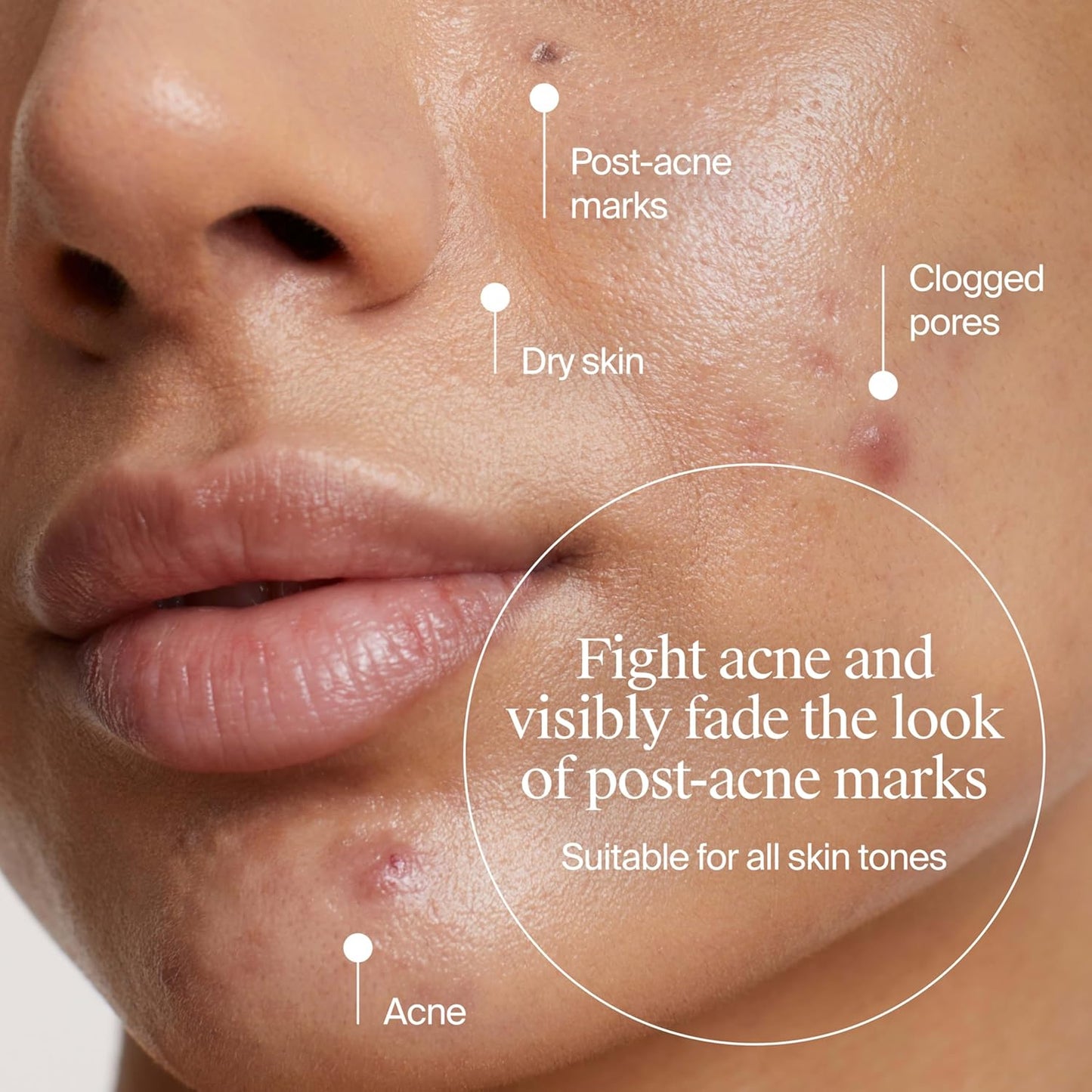 Neutrogena Hidratante de gel para acné uniformemente transparente con ácido salicílico y N-acetil glucosamina, hidratante facial ligero y no grasoso que ayuda a tratar brotes y desvanecer visiblemente