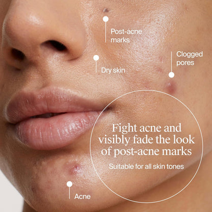 Neutrogena Hidratante de gel para acné uniformemente transparente con ácido salicílico y N-acetil glucosamina, hidratante facial ligero y no grasoso que ayuda a tratar brotes y desvanecer visiblemente