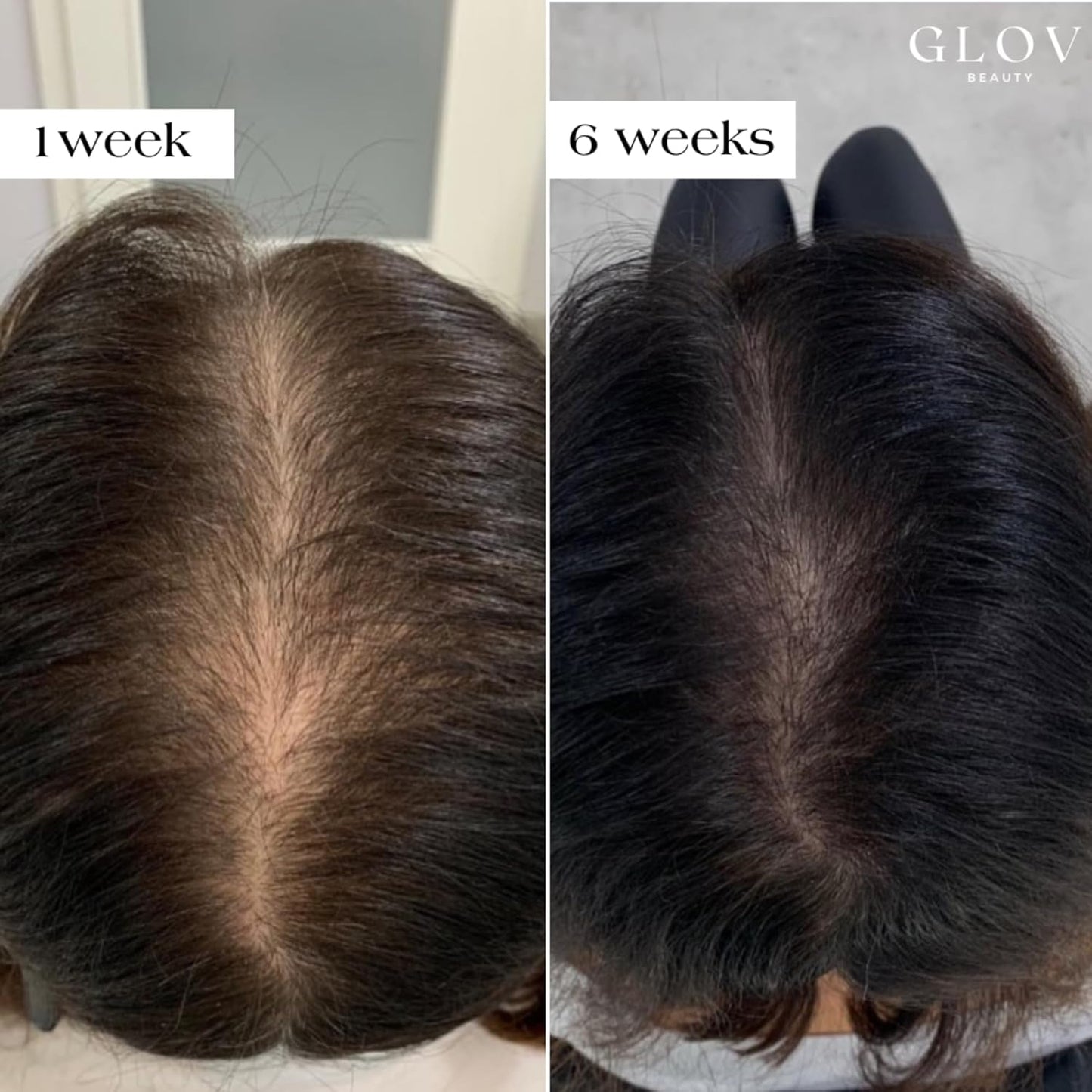Kit de Renovación Capilar Micro Infusión de Glov Beauty – Estampación Dérmica de Oro de 0.25 mm con Ácido Hialurónico, Péptido y Suero Ampollas Botánico | Tratamiento Hidratante para el Cuero