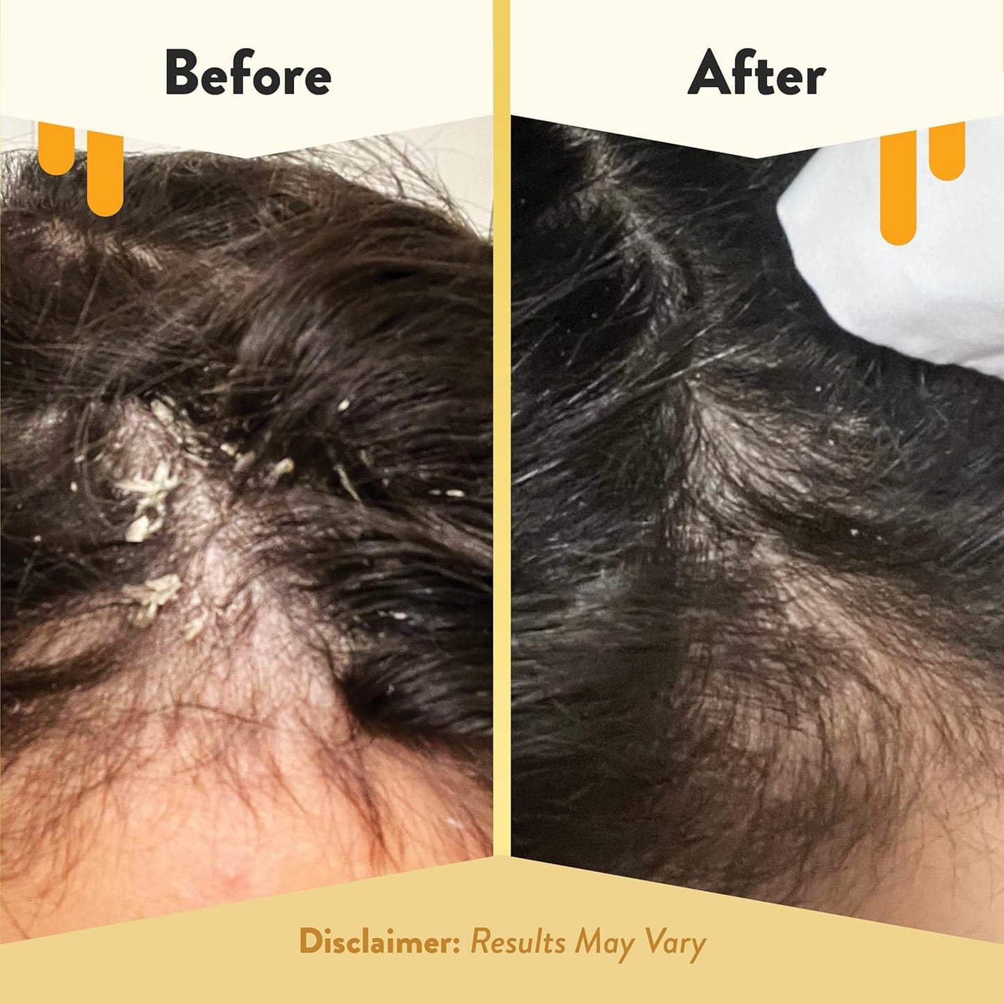 ECZEMA HONEY Aceite calmante para el cuero cabelludo, aceite natural de miel para el cabello y cuidado del cuero cabelludo, suero diario para aliviar la picazón del cuero cabelludo, el tratamiento del