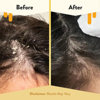 ECZEMA HONEY Aceite calmante para el cuero cabelludo, aceite natural de miel para el cabello y cuidado del cuero cabelludo, suero diario para aliviar la picazón del cuero cabelludo, el tratamiento del