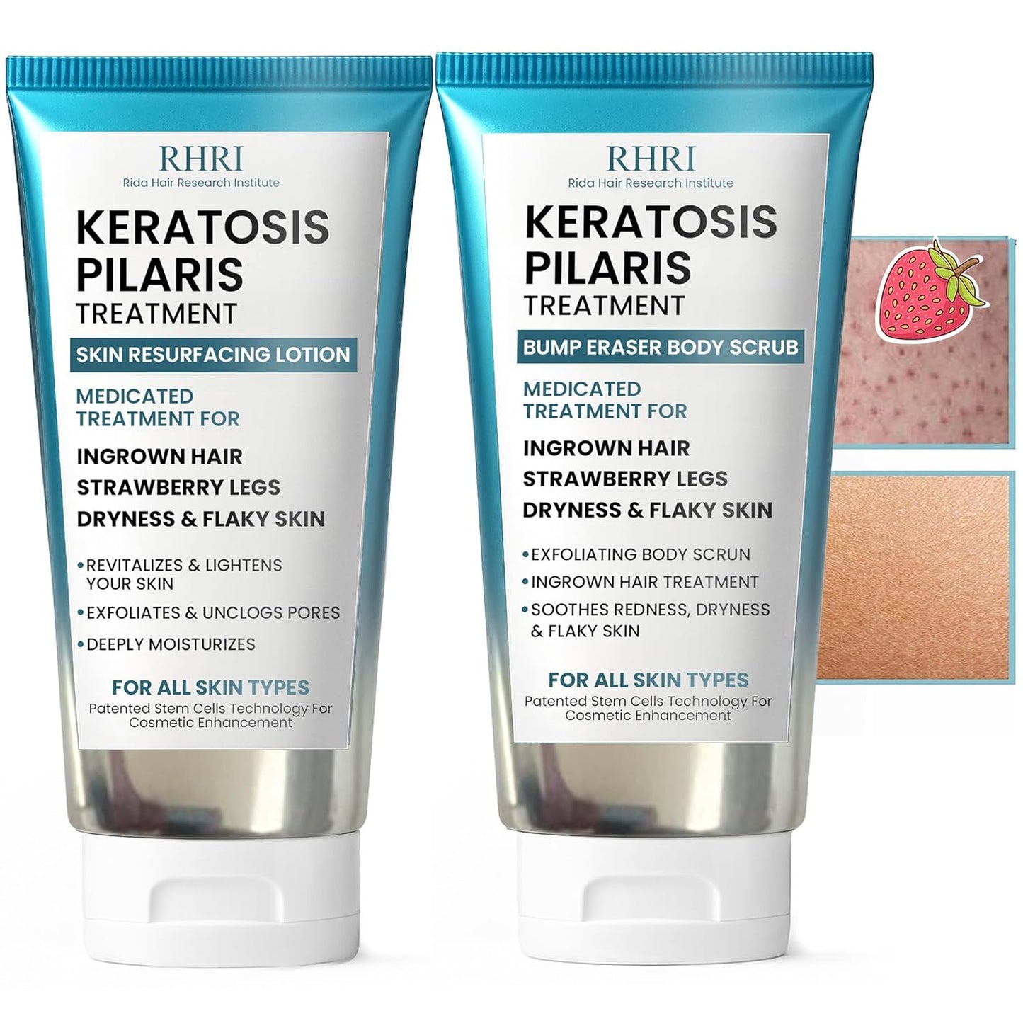 KP Bump Eraser Body Set con 10% AHA | Tratamiento de queratosis pil...