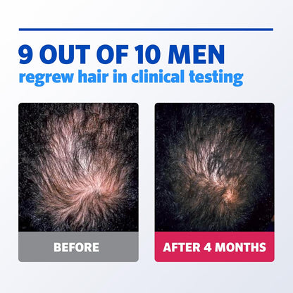 Rogaine para hombres 5% Minoxidil para hombres en espuma, crecimiento clínicamente probado para cabello adelgazado, tratamiento tópico para la pérdida de cabello, aerosol tópico sin perfume