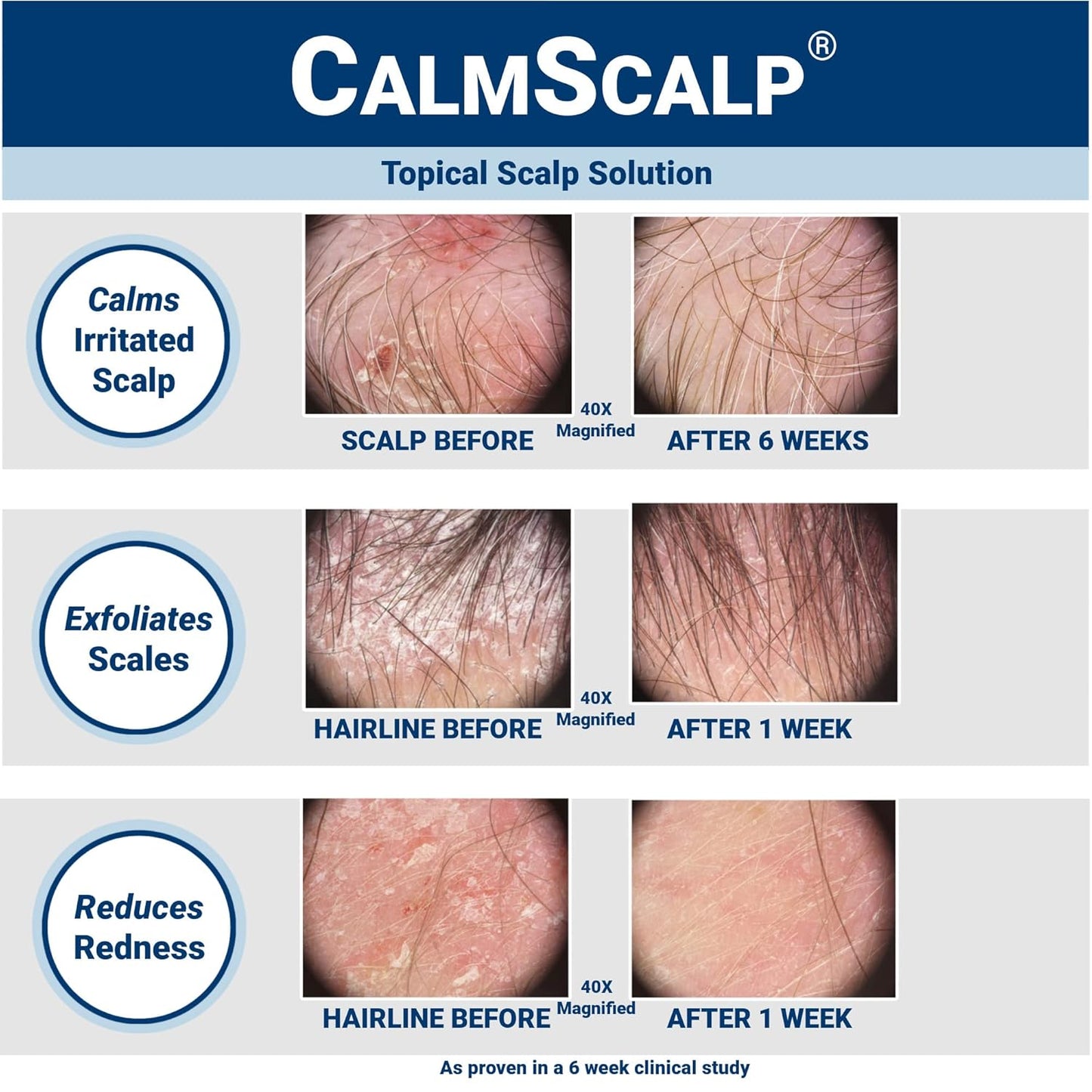 Sérum para el cuero cabelludo CalmScalp | Alivio de la picazón del cuero cabelludo | Tratamiento para el cuero cabelludo | Exfolia las escamas y las escamas de la línea del cabello | Clínicamente