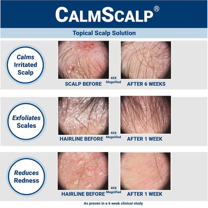 Sérum para el cuero cabelludo CalmScalp | Alivio de la picazón del cuero cabelludo | Tratamiento para el cuero cabelludo | Exfolia las escamas y las escamas de la línea del cabello | Clínicamente