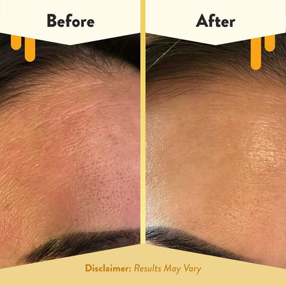 ECZEMA HONEY 15% de vitamina C + suero de ácido ferúlico, productos antienvejecimiento para el cuidado de la piel, aceite facial para eczema, piel seca y sensible (1 onza)