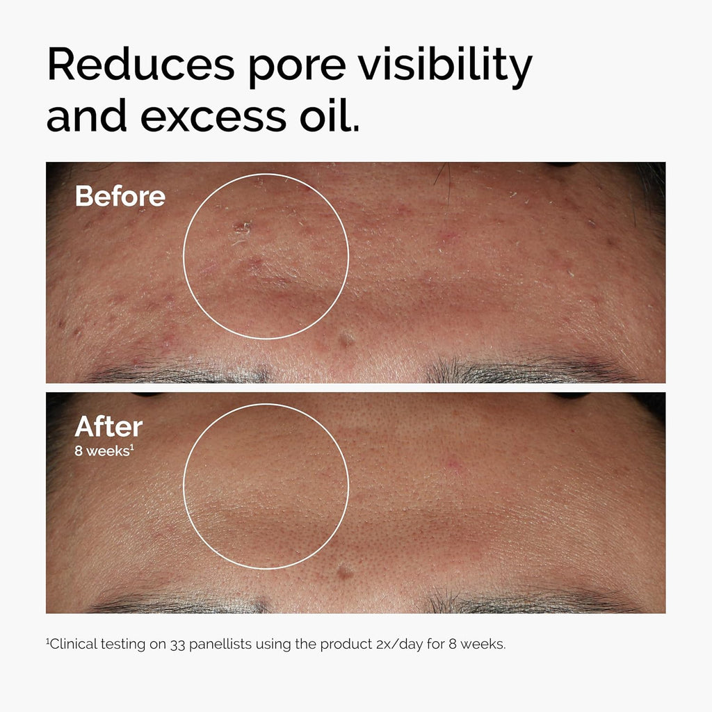 The Ordinary Niacinamide 10% + Zinc 1%, Smoothing Serum for Blemish...