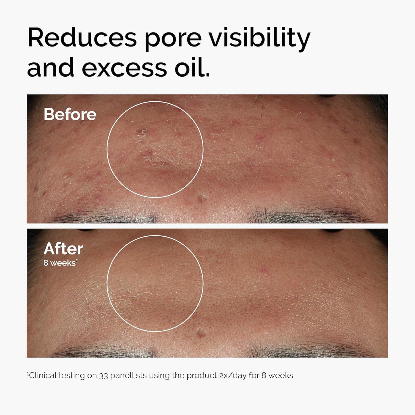 The Ordinary Niacinamide 10% + Zinc 1%, Smoothing Serum for Blemish...