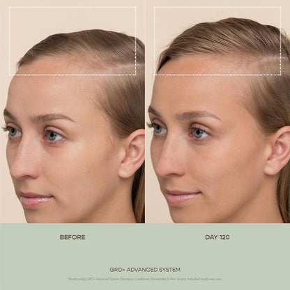VEGAMOUR GRO+ Advanced Dermaroller | 1,200 Microneedles de 0.25mm Herramienta para el cuero cabelludo | Exfolia suavemente el cuero cabelludo | Cabezal ancho para máxima cobertura