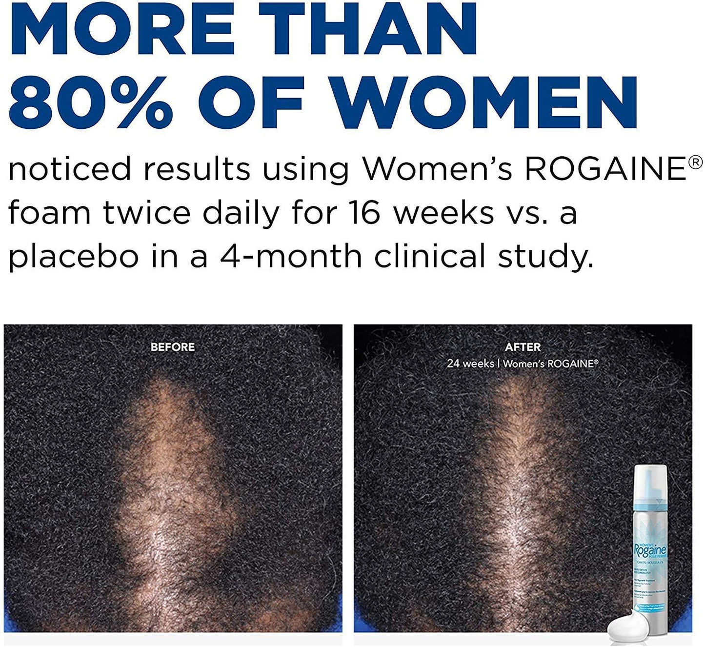 Rogaine - Espuma de minoxidil tópica al 5%, tratamiento contra la caída del cabello de una vez al día para mujeres para hacer crecer un cabello más abundante y grueso, sin perfume, suministro de 2