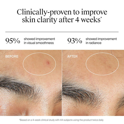 Neutrogena Hidratante de gel para acné uniformemente transparente con ácido salicílico y N-acetil glucosamina, hidratante facial ligero y no grasoso que ayuda a tratar brotes y desvanecer visiblemente