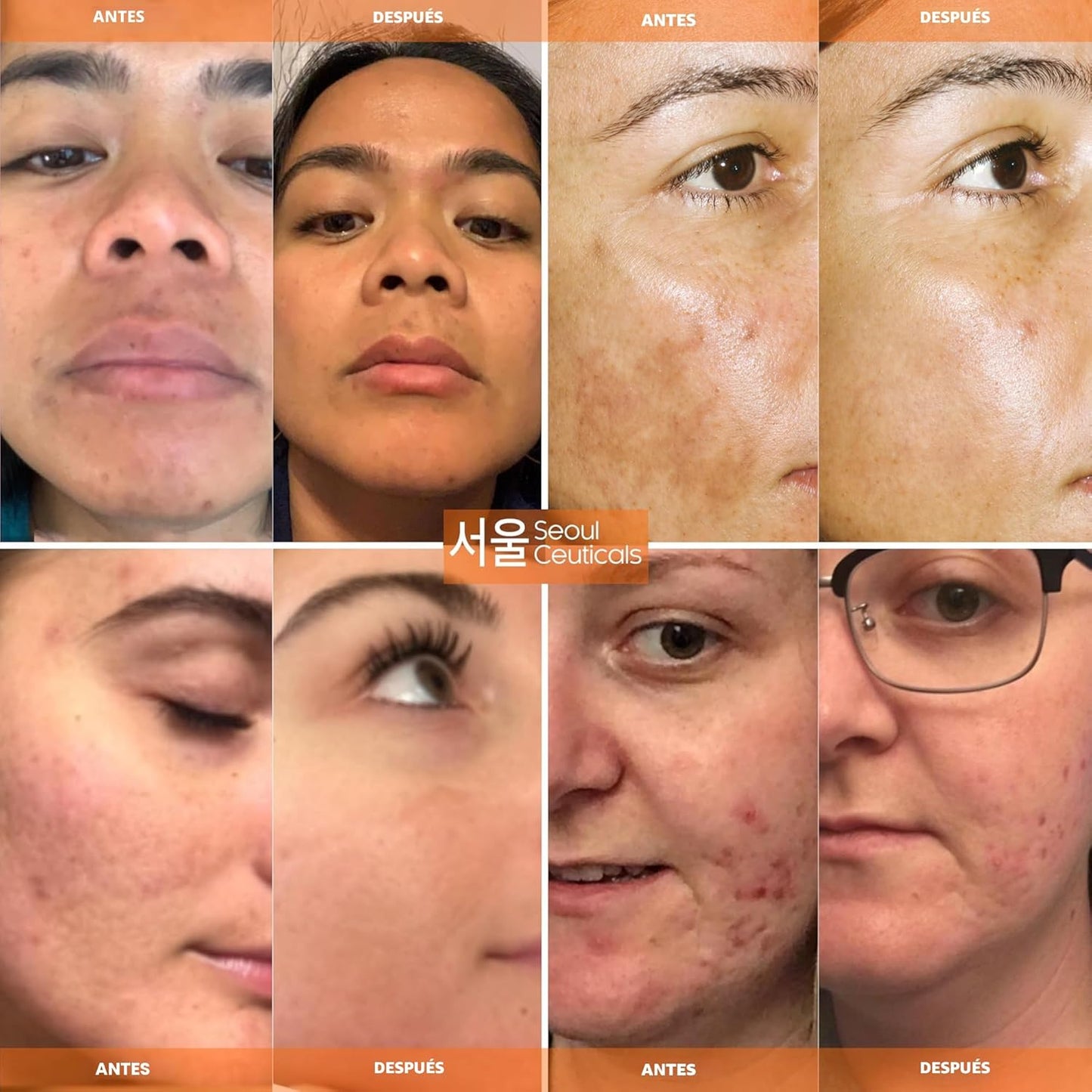 Korean Skin Care K Beauty - Sérum de ácido hialurónico 20% vitamina...